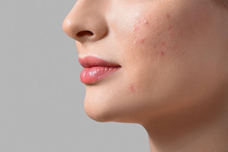 Article Routine visage peau acneique